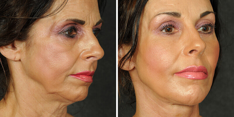 Dr. Kao Ponytail Face Lift