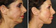 Dr. Kao Ponytail Face Lift