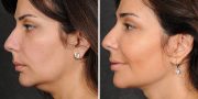 Dr. Kao Ponytail Face Lift