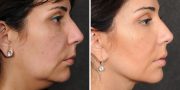 Dr. Kao Ponytail Face Lift