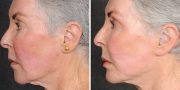 Dr. Kao Ponytail Face Lift