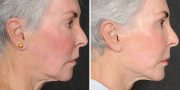 Dr. Kao Ponytail Face Lift