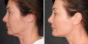 Dr. Kao Ponytail Face Lift