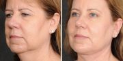 Dr. Kao Ponytail Face Lift