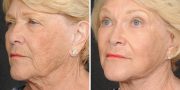 Dr. Kao Ponytail Face Lift