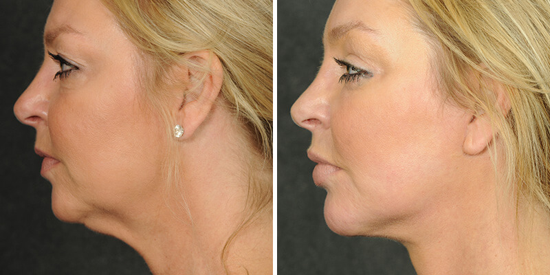 Dr. Kao Ponytail Face Lift