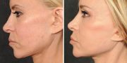 Dr. Kao Ponytail Face Lift