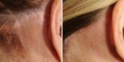 Dr. Kao Ponytail Face Lift Scarring