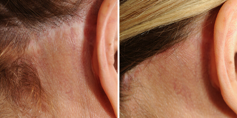 Dr. Kao Ponytail Face Lift Scarring