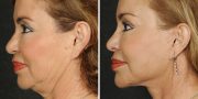 Dr. Kao Ponytail Face Lift