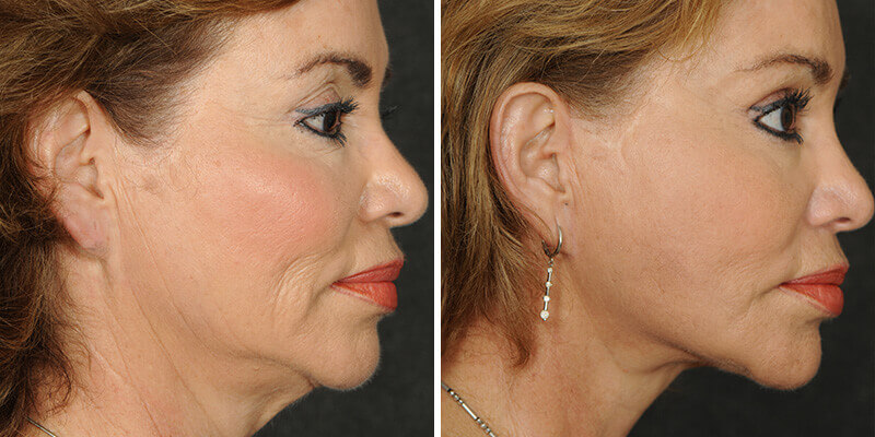 Dr. Kao Ponytail Face Lift