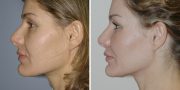 Dr. Kao Ponytail Face Lift