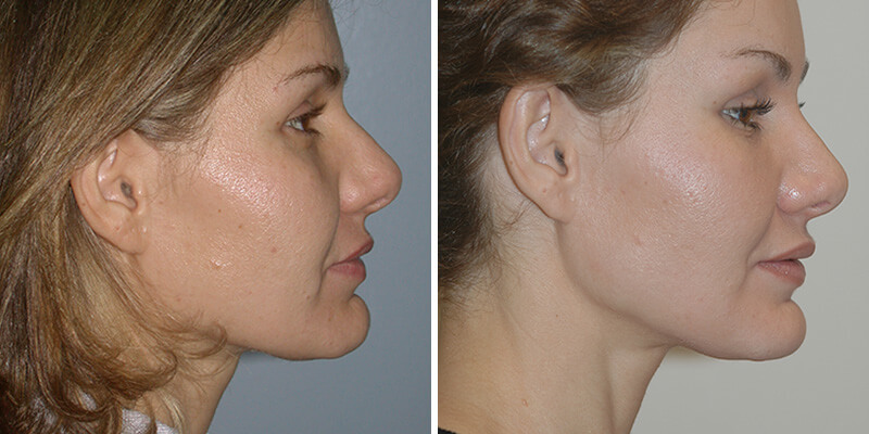 Dr. Kao Ponytail Face Lift