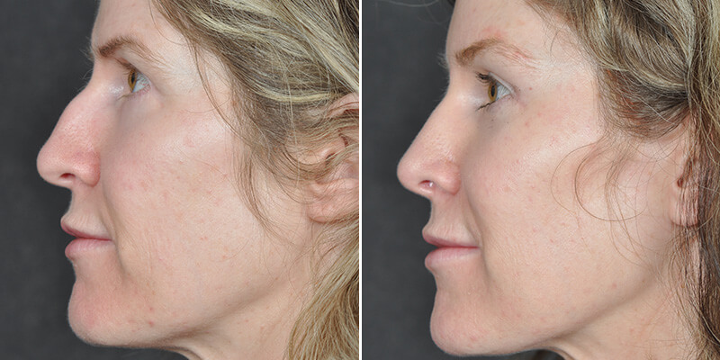 Dr. Kao Rhinoplasty