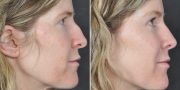 Dr. Kao Rhinoplasty