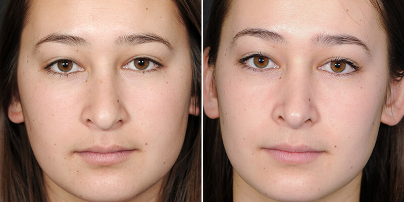 Dr. Kao Rhinoplasty