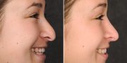 Dr. Kao Rhinoplasty