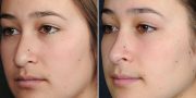 Dr. Kao Rhinoplasty