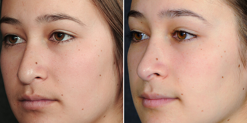 Dr. Kao Rhinoplasty