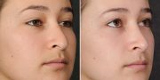 Dr. Kao Rhinoplasty