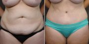 Dr. Kao Tummy Tuck (Abdominoplasty)