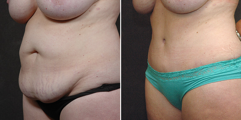 Dr. Kao Tummy Tuck (Abdominoplasty)