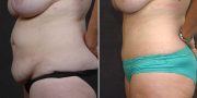 Dr. Kao Tummy Tuck (Abdominoplasty)