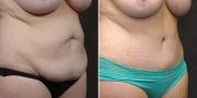 Dr. Kao Tummy Tuck (Abdominoplasty)