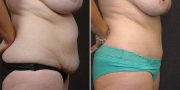 Dr. Kao Tummy Tuck (Abdominoplasty)