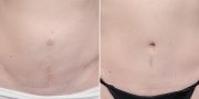 Dr. Kao Tummy Tuck (Abdominoplasty)