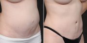 Dr. Kao Tummy Tuck (Abdominoplasty)