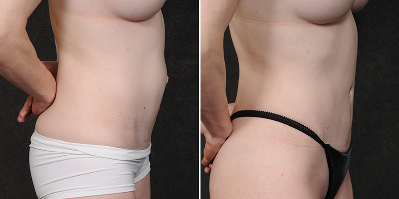 Dr. Kao Tummy Tuck (Abdominoplasty)