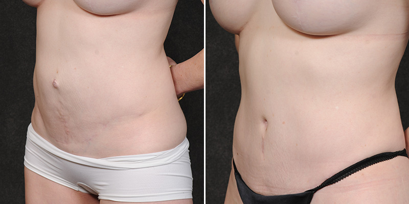 Dr. Kao Tummy Tuck (Abdominoplasty)