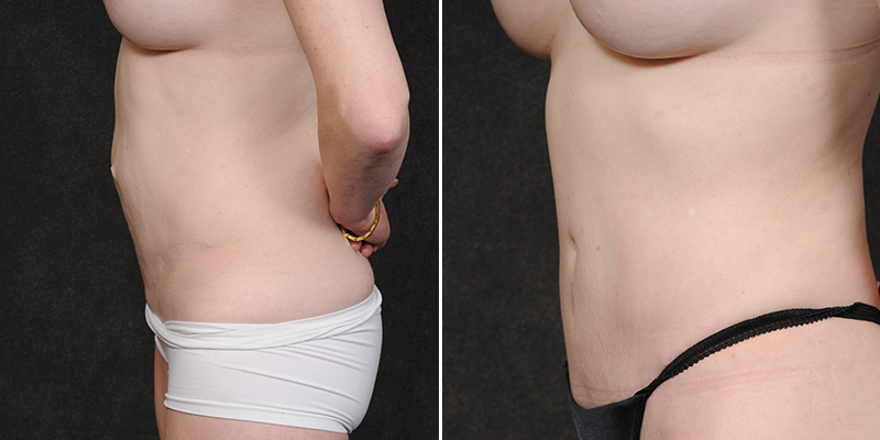 Dr. Kao Tummy Tuck (Abdominoplasty)