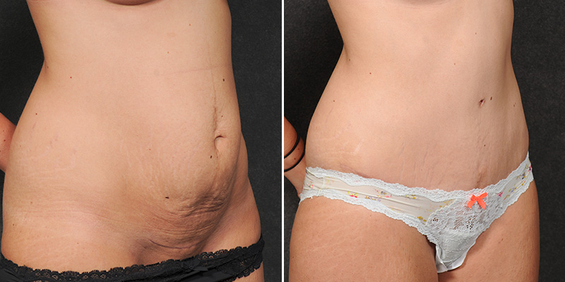 Dr. Kao Tummy Tuck (Abdominoplasty)