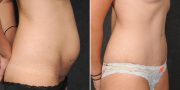 Dr. Kao Tummy Tuck (Abdominoplasty)