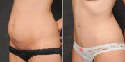 Dr. Kao Tummy Tuck (Abdominoplasty)