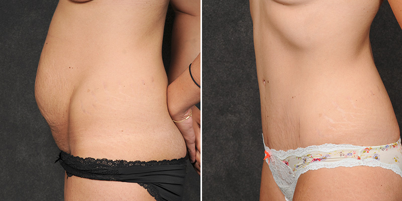 Dr. Kao Tummy Tuck (Abdominoplasty)