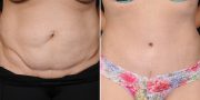 Dr. Kao Tummy Tuck (Abdominoplasty)