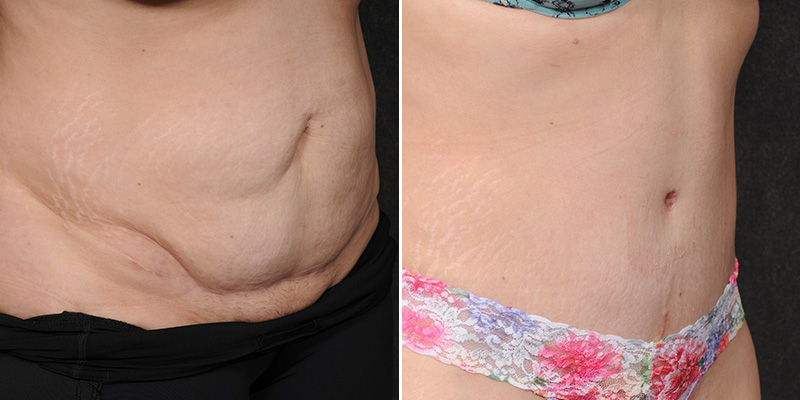 Dr. Kao Tummy Tuck (Abdominoplasty)