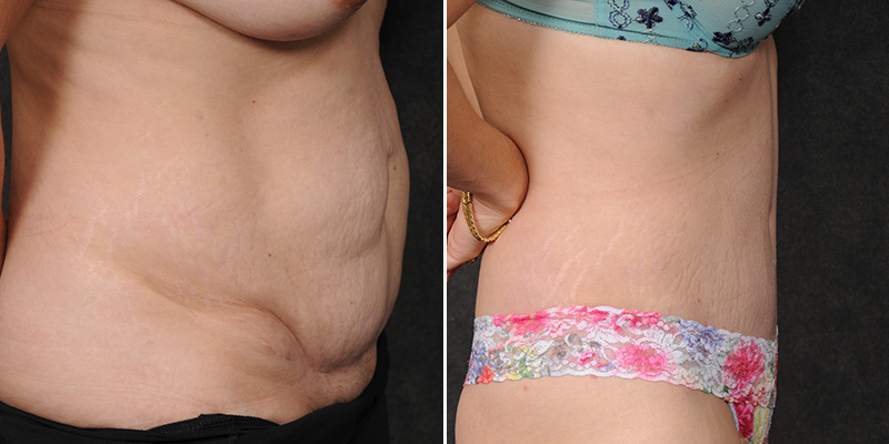 Dr. Kao Tummy Tuck (Abdominoplasty)