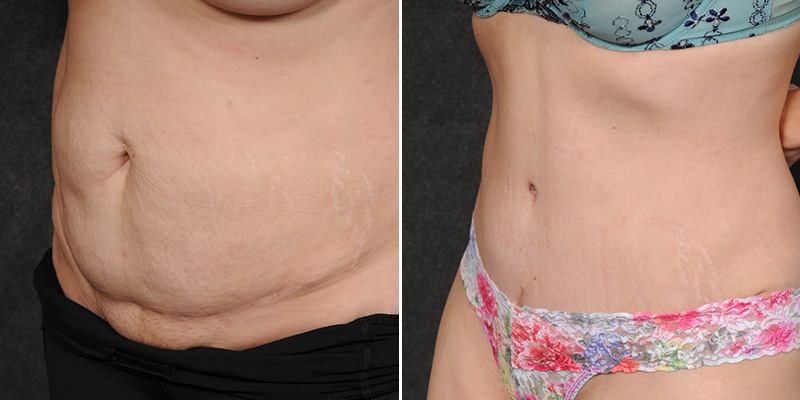 Dr. Kao Tummy Tuck (Abdominoplasty)