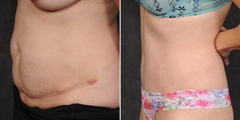 Dr. Kao Tummy Tuck (Abdominoplasty)