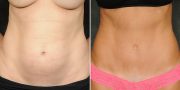 Dr. Kao Tummy Tuck (Abdominoplasty)