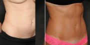 Dr. Kao Tummy Tuck (Abdominoplasty)