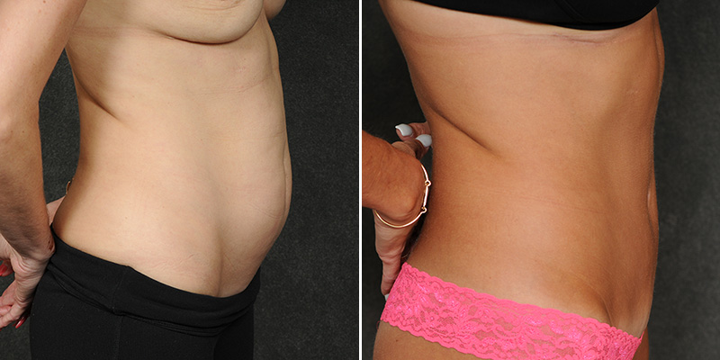 Dr. Kao Tummy Tuck (Abdominoplasty)