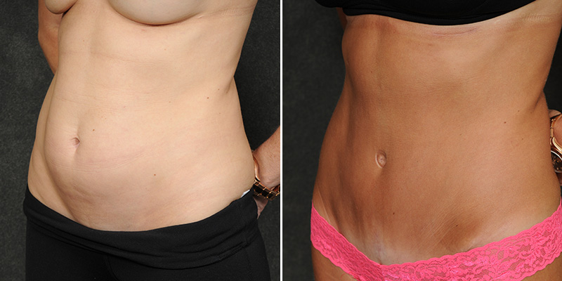 Dr. Kao Tummy Tuck (Abdominoplasty)