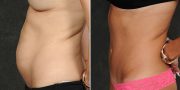 Dr. Kao Tummy Tuck (Abdominoplasty)