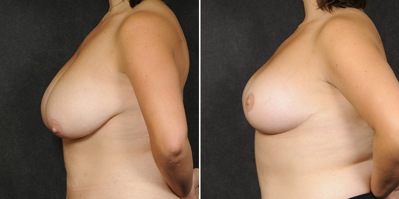 Dr. Kao Breast Reduction