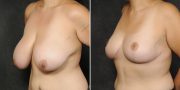 Dr. Kao Breast Reduction